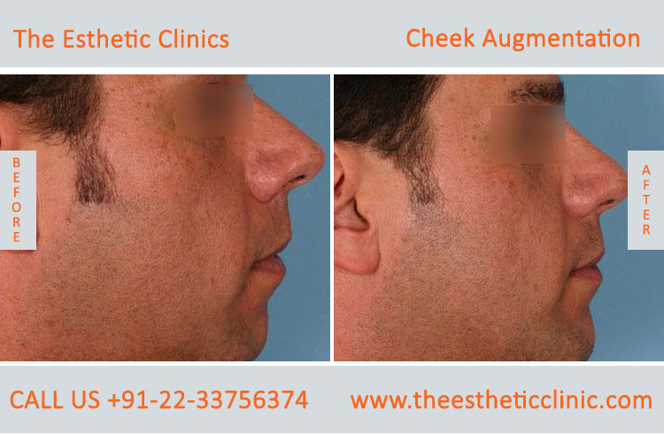 Cheek Augmentation, Cheek Implants surgery before after photos in mumbai india (3)